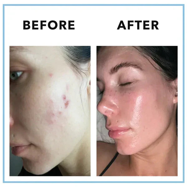 CLEARSTEM MINDBODYSKIN™ Vitamin Supplement – Hormonal Acne & Skin Balance Formula – 90 Capsules